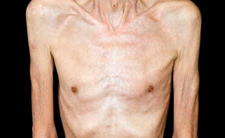 Weight loss associated with HIV