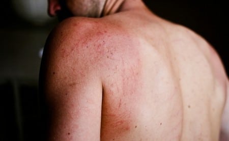 HIV Rash