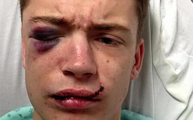 Young Man Beaten With a Beer Bottle for Being Gay