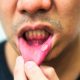 Man with mouth sores