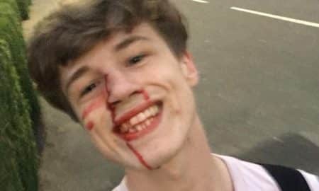 Gay Man Shares Bloody Selfie After Scrap With Homophobe